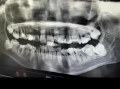 拔智齿视频,视频带你直观体验