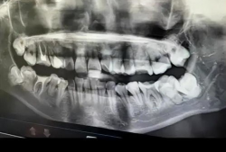 拔智齿视频,视频带你直观体验