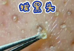 挤黑头痘痘视频,告别肌肤困扰